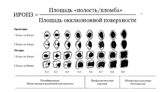 ИРОПЗ - индекс разрушенности окклюзионной (жевательной) поверхности зуба